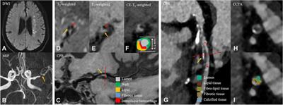 The value of coordinated analysis of multimodal atherosclerotic plaque imaging in the assessment of cardiovascular and cerebrovascular events